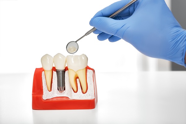 Oral Surgery For Dental Implant