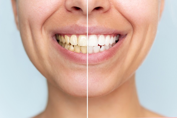 Take Home Teeth Whitening Trays Vs  Over The Counter Whitening Products